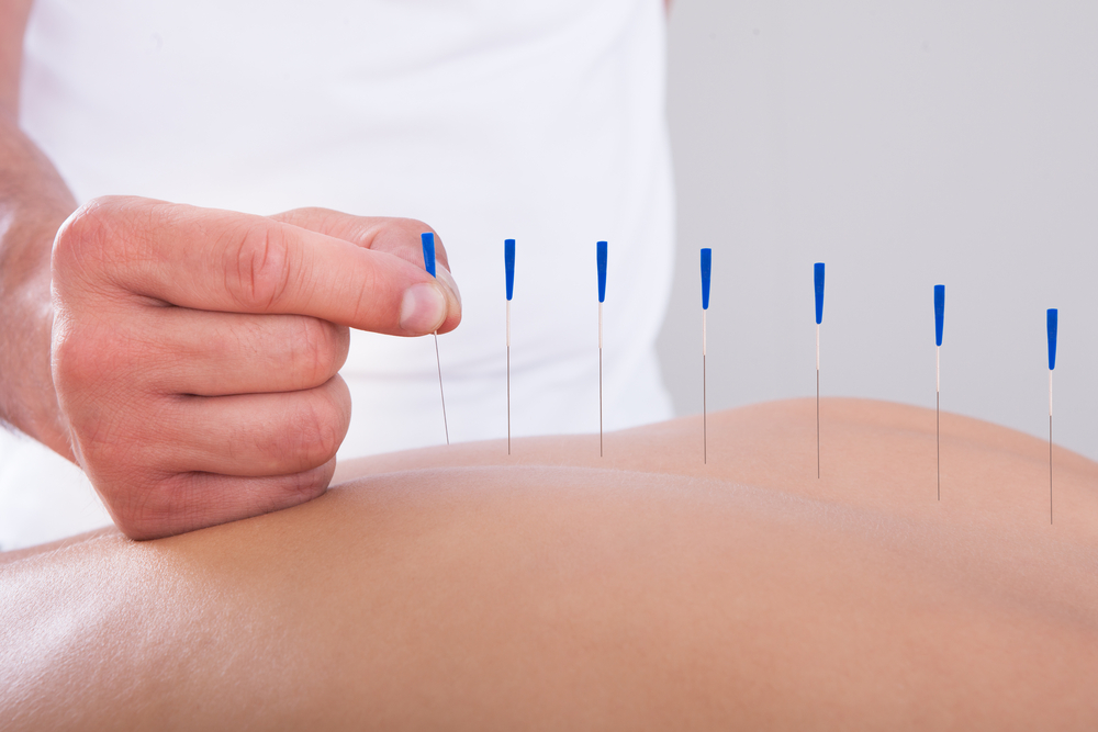 Benefits of acupuncture are shown on a patient in Guelph
